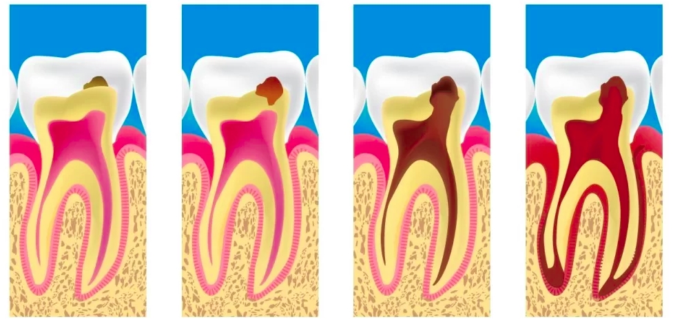 Caria dentară, de la cauză la efect